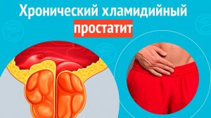 😧 Хронический хламидийный простатит. Клинический случай № 1754