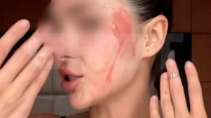 Москвичка едва не ослепла на Бали: она во сне раздавила ядовитое насекомое и получила жуткий ожог ли