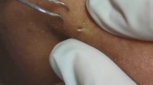 #78 Чистка лица от угрей и акне. Выдавливание прыщей. Удаление черных точек и комедонов