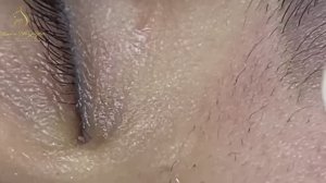 Профессиональный способ, как мы избавляемся от милиумов. LN31tt