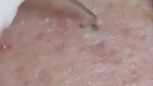 Чистка лица от угрей и акне. Выдавливание прыщей. Удаление черных точек и комедонов