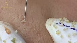 Asmr. Профессиональное удаление от белых точек. LN4tt