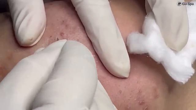 Лечим закрытые комедоны: частный случай.