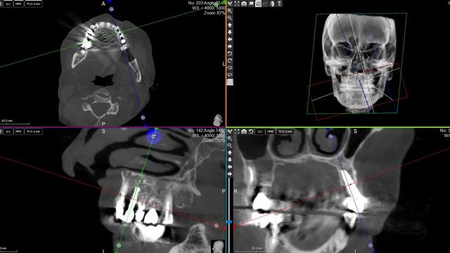 Рентгенологическая картина костной ткани вокруг имплантов системы AB-Dental - область 24,26-2013 год