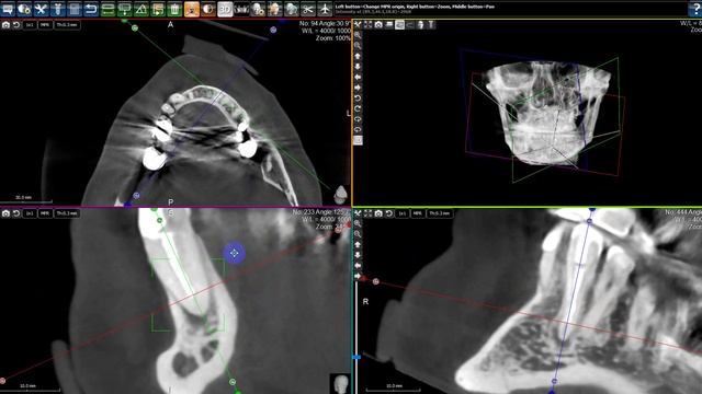 КЛКТ диагностика. Хронический апикальный периодонтит 33.
