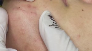 Комплексная чистка лица (удаление закрытых комедонов) #ТТ59