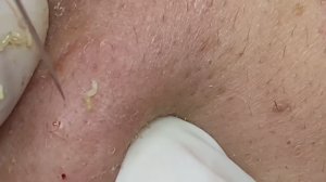 Удаление подкожных прыщей #ТТ52