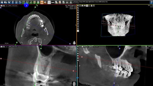 КЛКТ диагностика. Хронический апикальный периодонтит 16.