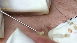 Asmr. Профессиональное удаление от прыщей LN27tt