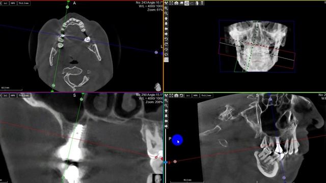 Рентгенологическая картина костной ткани вокруг имплантов системы ALFA-BIO -2017 год установки.