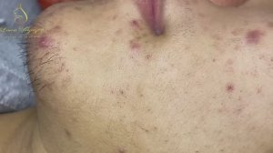 Очищение лица от милиумов: реальная чистка LN37tt