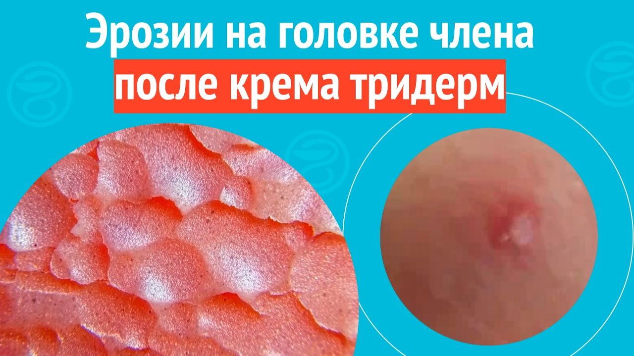 🙁 Эрозии на головке члена после крема тридерм. Клинический случай № 1749