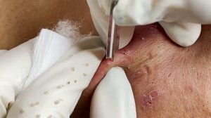 Asmr. Очищение кожи от белых точек.