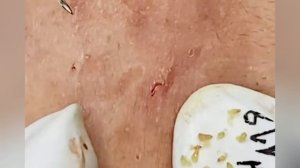 Выдавливание прыщей, угрей, черных точек и камедонов #238