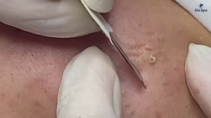 Профессиональная чистка от закрытых комедонов