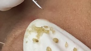 Выдавливание прыщей, угрей, черных точек и камедонов #236