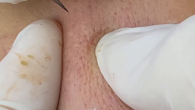 Мелкие подкожные бугорки (закрытые комедоны) — #ТТ60