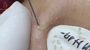 Профессиональное избавление от милиумов за один сеанс LN29tt