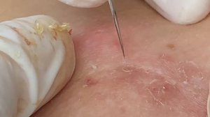 Очищение кожи от подкожных прыщей и закрытых комедонов #ТТ58