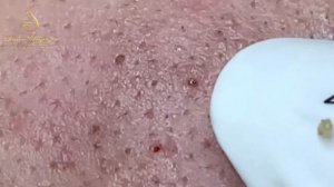 Проверенный способ, как мы избавляемся от белых точек LN35tt