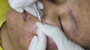 Как дерматолог лечит милиумы: метод удаления LN36tt