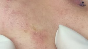 Очищение кожи, склонной к образованию милиумов