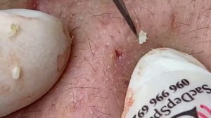 Выдавливание прыщей, угрей, черных точек и камедонов #237