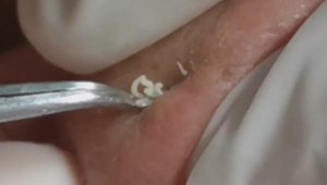 #79 Чистка лица от угрей и акне. Выдавливание прыщей. Удаление черных точек и комедонов