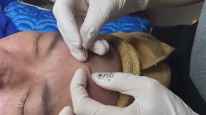 Механическая чистка при угревой сыпи - ТТ#77_1