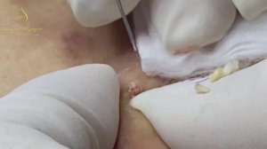 Профессиональная чистка лица от милиумов LN9yy