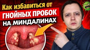КАК УБРАТЬ ГНОЙНЫЕ ПРОБКИ НА МИНДАЛИНАХ В ДОМАШНИХ УСЛОВИЯХ. ГНОЙНЫЕ ПРОБКИ В ГОРЛЕ ЛЕЧЕНИЕ ДОМА