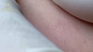 Профессиональное избавление от милиумов за один сеанс LN29tt