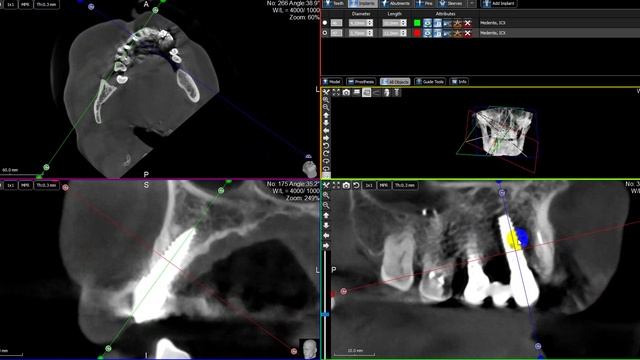 Состояние имплантов системы AB-Dental спустя 12 лет.
