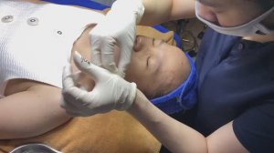 Удаление комедонов и акне у мужчины - #ТТ62