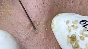 Механическое очищение кожи от закрытых комедонов: техника. LN30tt