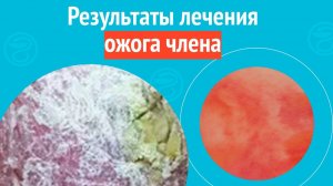 ✅ Результаты лечения ожога члена. Клинический случай № 1753