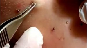 Чистка лица от угрей и акне. Выдавливание прыщей. Удаление черных точек и комедонов