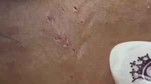 Лучшее выдавливание прыщей | Гигантские черные точки - SDS#169