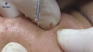 Лечение белых точек на лице: милиумы, закрытые комедоны