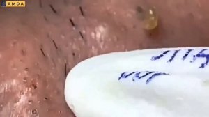 Удаление милиумов у косметолога: тонкая работа. #887627