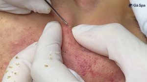 Asmr. Профессиональное избавление от акне.