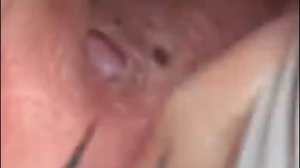 Чистка лица от угрей и акне. Выдавливание прыщей. Удаление черных точек и комедонов