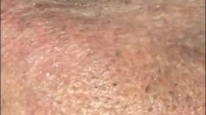 Чистка лица от угрей и акне. Выдавливание прыщей. Удаление черных точек и комедонов