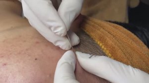 Как избавиться от подкожных прыщей | Удаление закрытых комедонов - SDS#168