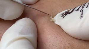 Избавление от открытых комедонов | Удаление черных точек с кожи - SDS#162