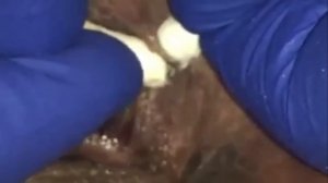 Чистка лица от угрей и акне. Выдавливание прыщей. Удаление черных точек и комедонов