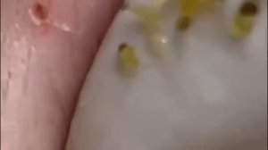 Чистка лица от угрей и акне. Выдавливание прыщей. Удаление черных точек и комедонов