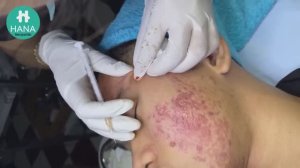 Asmr. Чистим кожу от угрей HANA #08