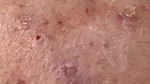 Asmr. Выдавливание акне и белых точек 𝐖𝐢𝐧 #𝟏𝟎𝟎𝟎