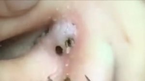 Чистка лица от угрей и акне. Выдавливание прыщей. Удаление черных точек и комедонов